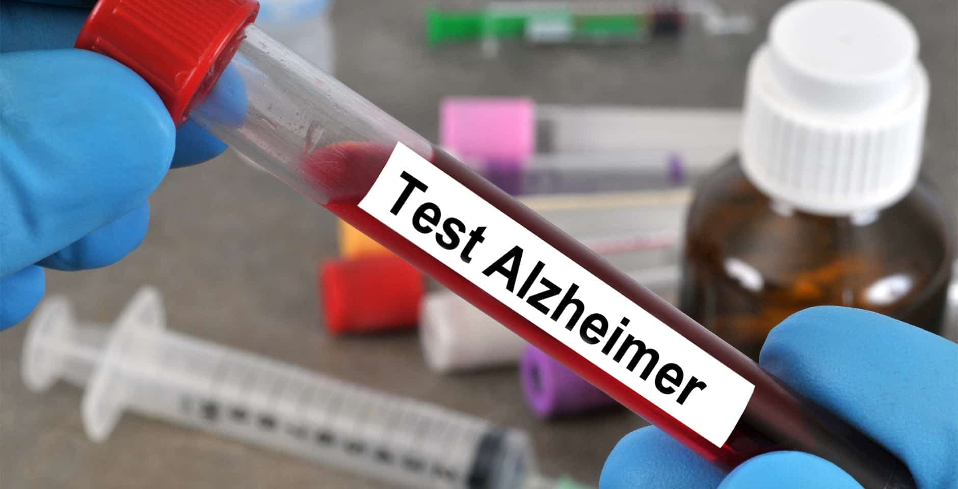 Provrör med blod märkt "Test Alzheimer."